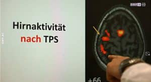 Hirnaktivität nach TPS - Parkinson - Alzheimer Science