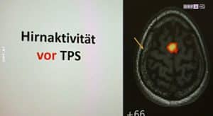 Brain activity before TPS - Parkinson's - Alzheimer Science